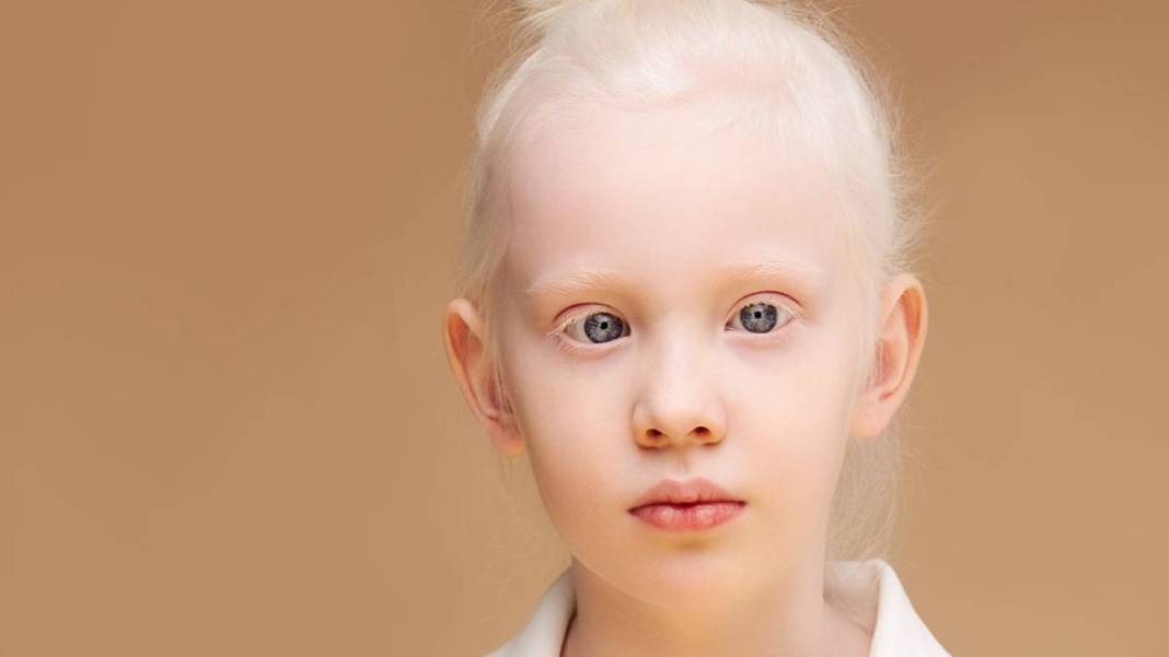 Gözünüz renkliyse dikkat! Büyük sır ortaya çıktı: Meğer o genetik özellik... 6